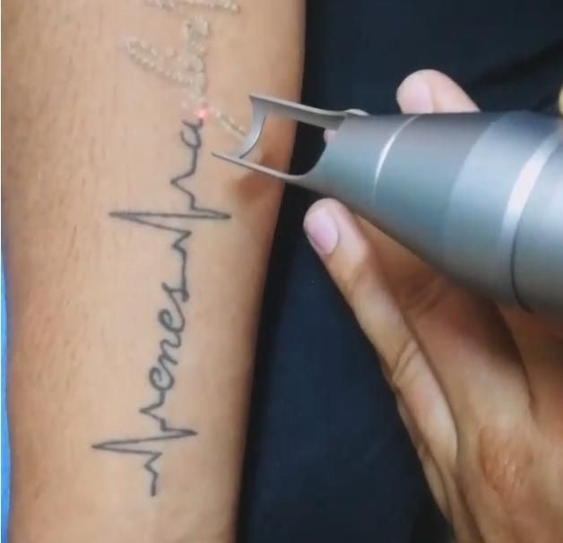 Tattoo Removal Packages (12 TREATMENTS)