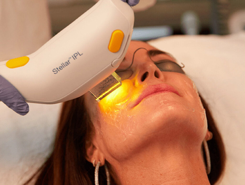IPL (PHOTOFACIAL)